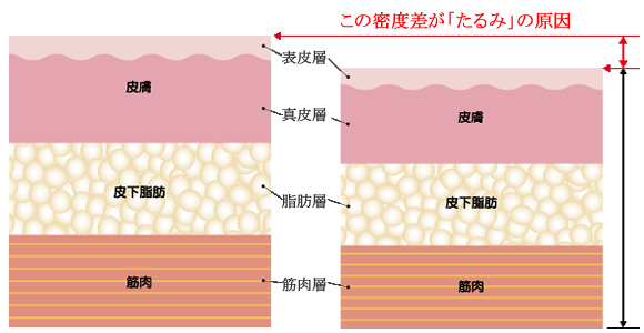「たるみ」の原因